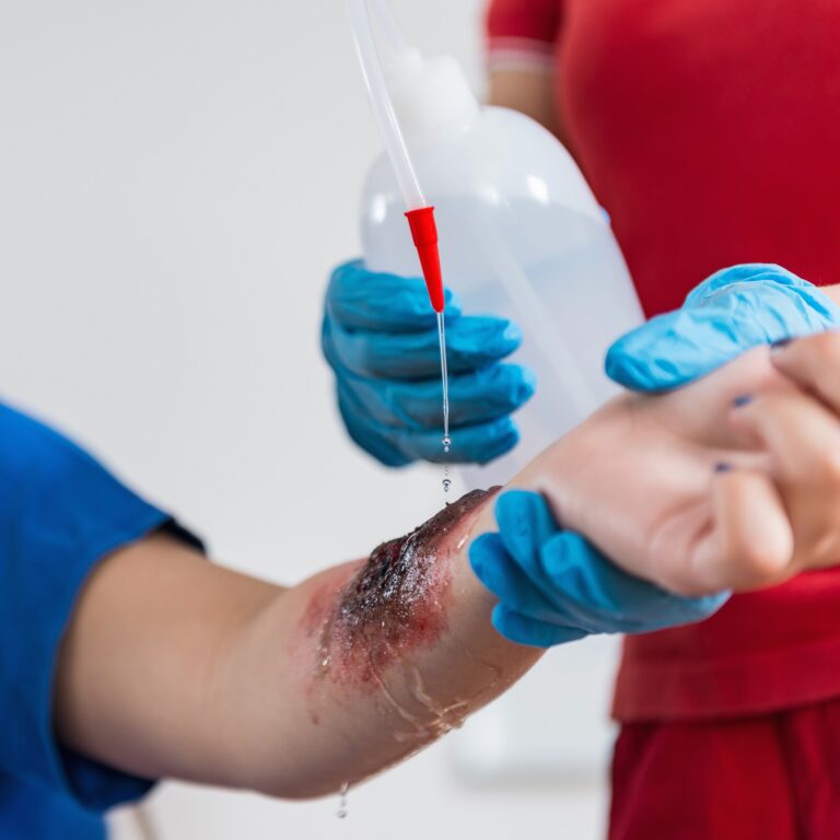 Soothing the Sting: Home Remedies for Minor Burns Soothing the Sting Home Remedies for Minor Burns, mend.zone