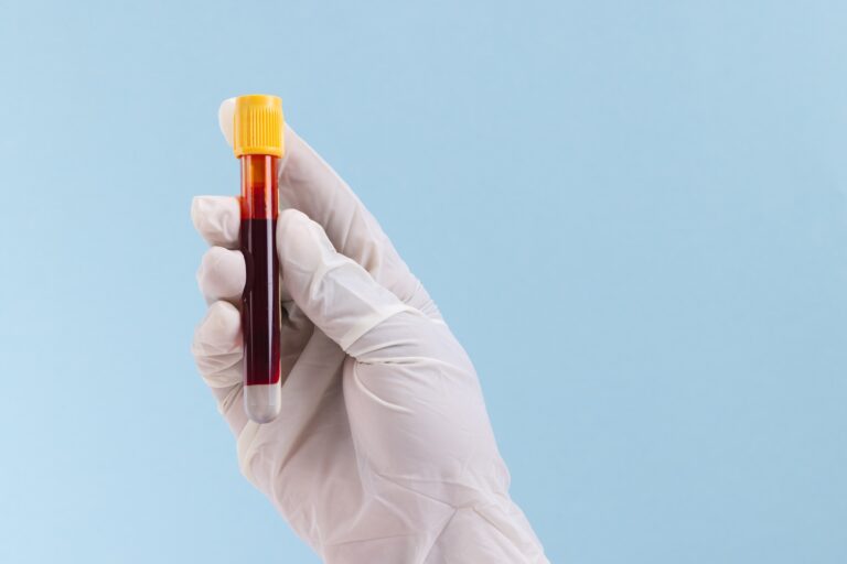 Uric Acid Blood Test at Home | Uric Acid Test Near Me: Understanding Gout and Managing Your Uric Acid Levels Uric Acid Blood Test at Home Uric Acid Test Near Me Understanding Gout and Managing Your Uric Acid Levels