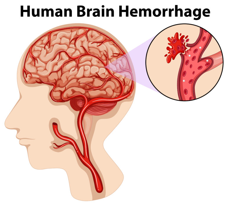Human Brain Hemorrhage: Symptoms, Causes, and Effective Treatments