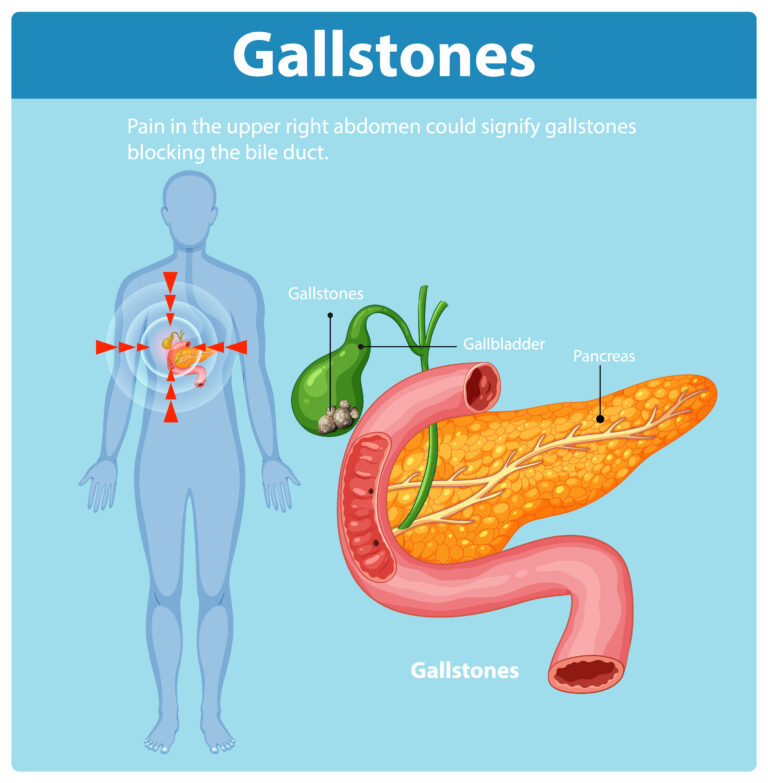 Gallbladder Stone Symptoms, Causes, and Treatment | Gallstones Diagnosis Near Me